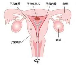 子宮体がん