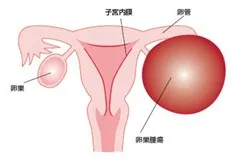 卵巣腫瘍