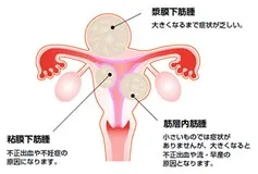 子宮筋腫