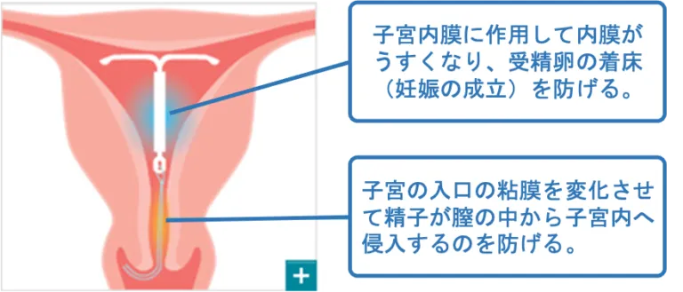 ミレーナ(IUS)とは